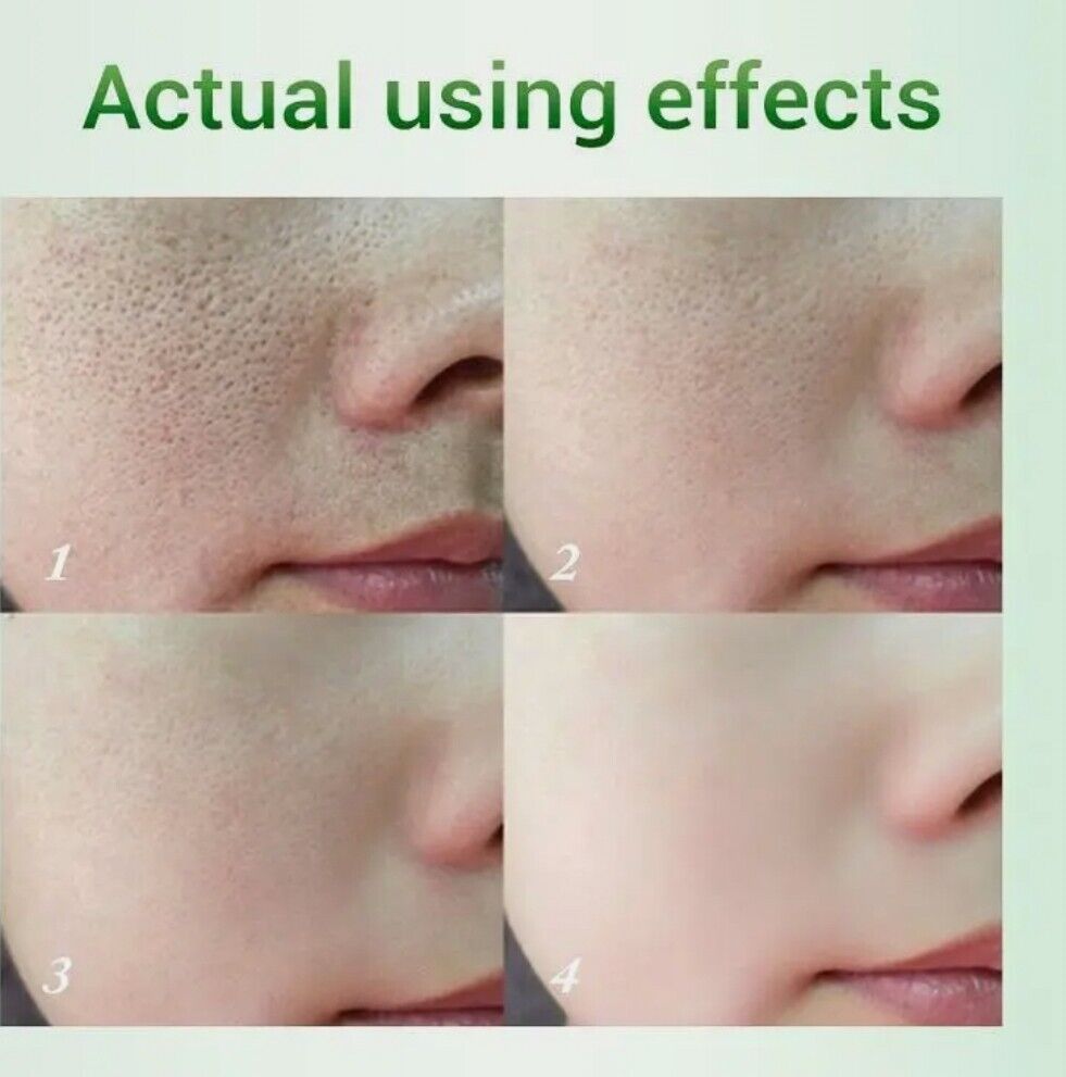 Salicylic Acid Pores Refining Cream Shrink Pore Improve Acnes Blackheads