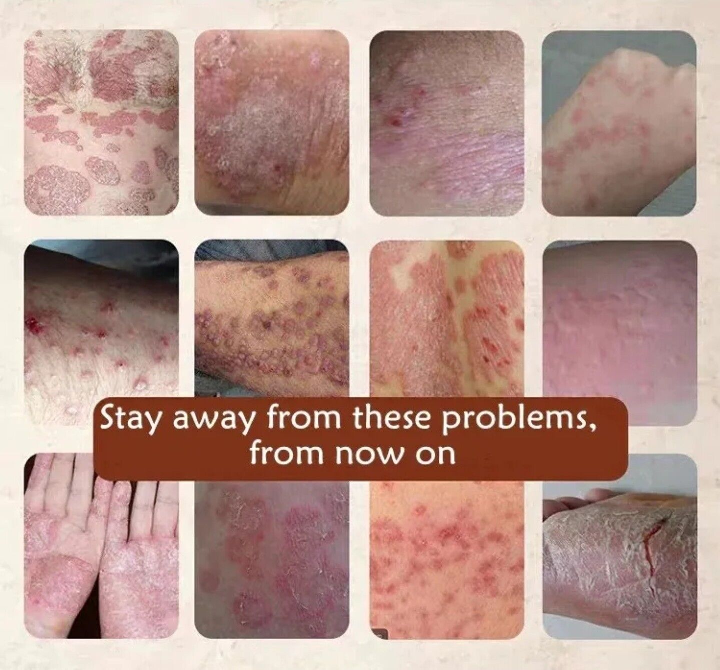 New Body Psoriasis Cream All Body Skin Care Bacteriostasis Dermatitis Eczema 20g