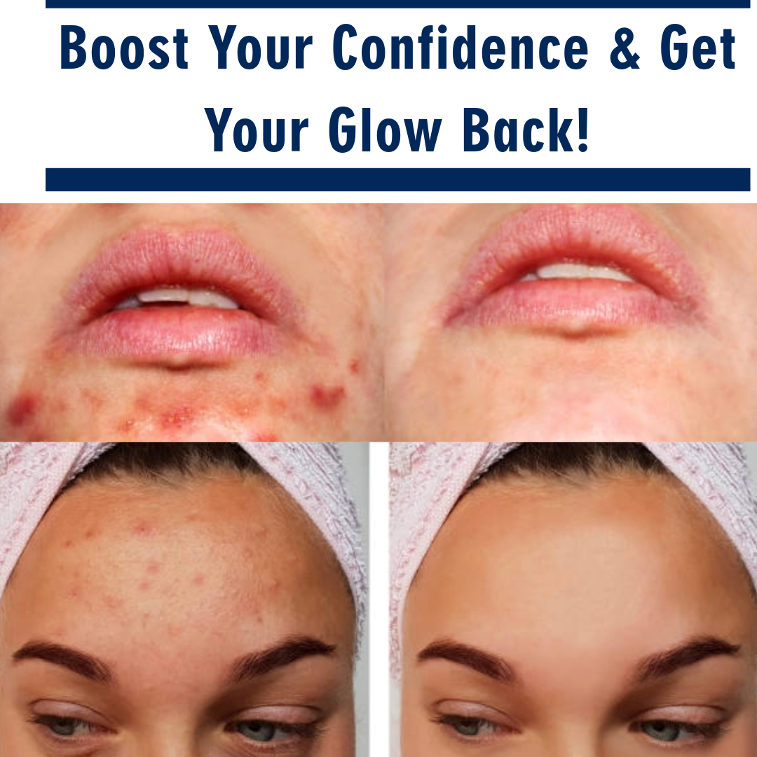 New Effective Acne Removal Cream Acne Treatment Skin Whitening Pimple Acne Cream
