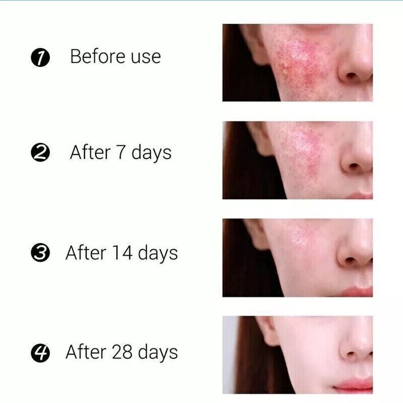 Strong Acne Scar Spots Removal Cream Cuts Burns Stretch Marks Clarifying Skin UK