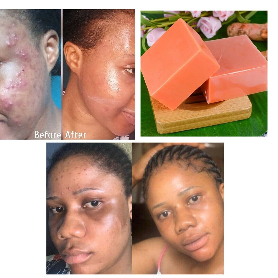 Tumeric Soap,Dark Spots ,Skin Glow, Brighter Skin, Scars, All Skin types Natural