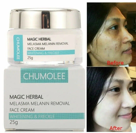 2X Strong Removal Melasma Whitening Cream Freckle Speckle Spots Melanin Pigment