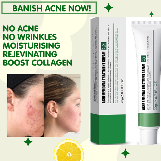 Strong Acne Scar Spots Removal Cream Cuts Burns Stretch Marks Clarifying Skin UK