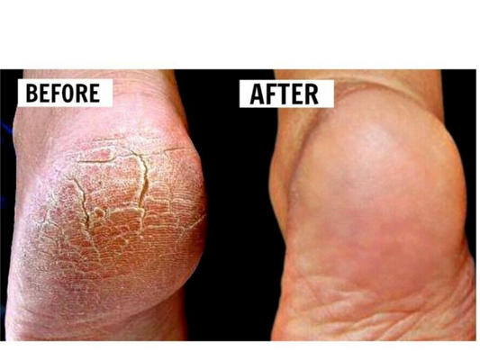 Foot Cream Cracked Heels Repair Treatment For Very Dry Feet  Hard Skin Cream