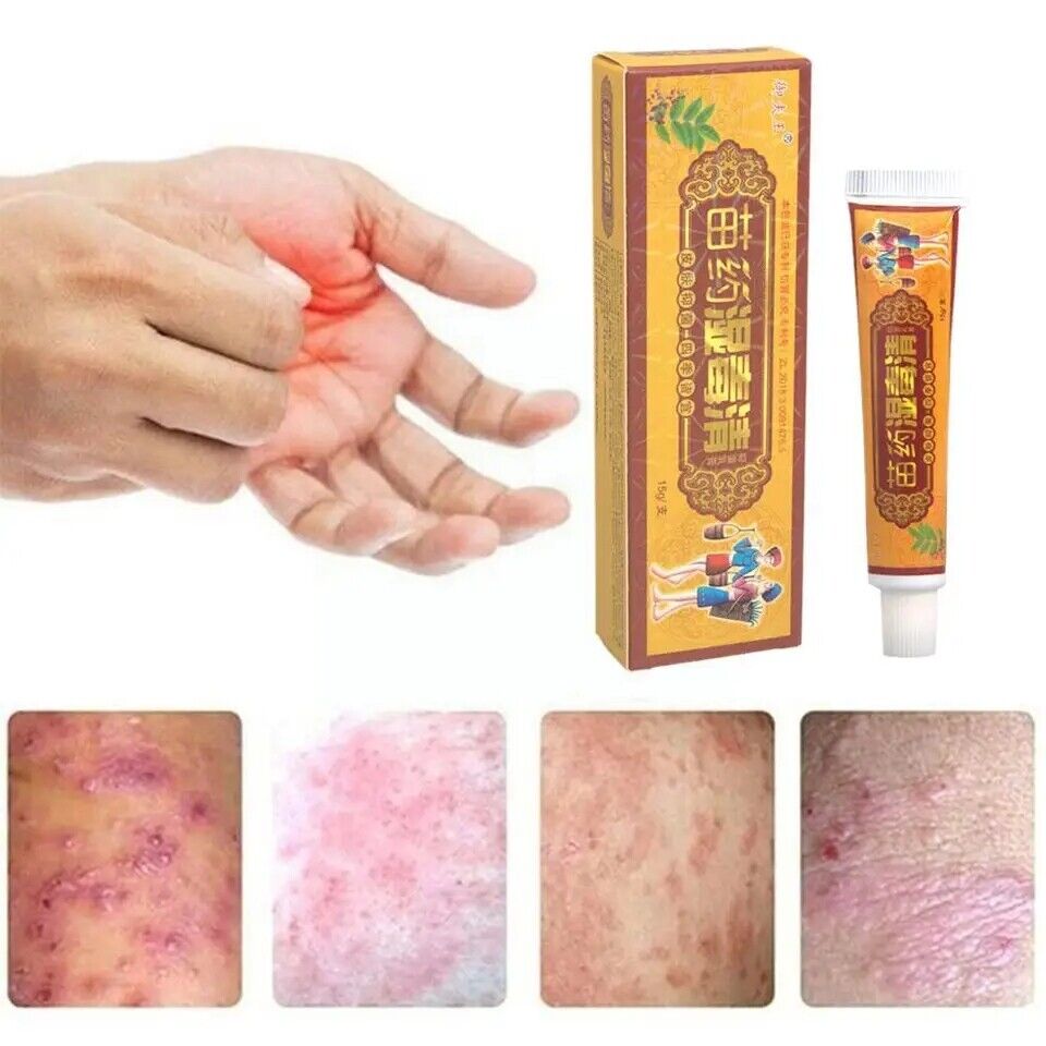 New Body Psoriasis Cream All Body Skin Care Bacteriostasis Dermatitis Eczema 20g