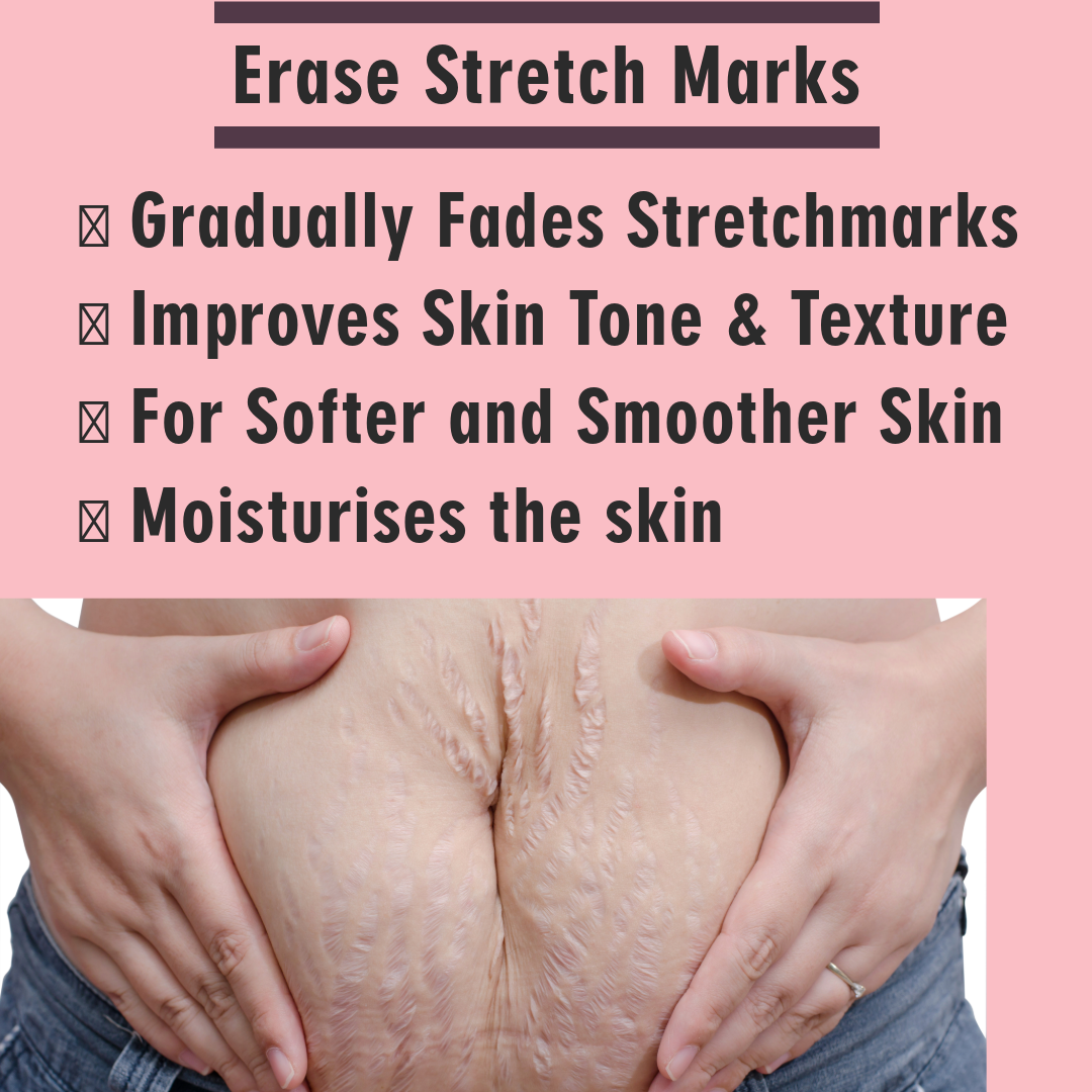 Stretch Mark Remover Repair Cream For Postpartum Pregnancy Scar  Skin Care